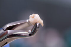 extractii-dentare