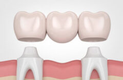 punti si coroane dentare