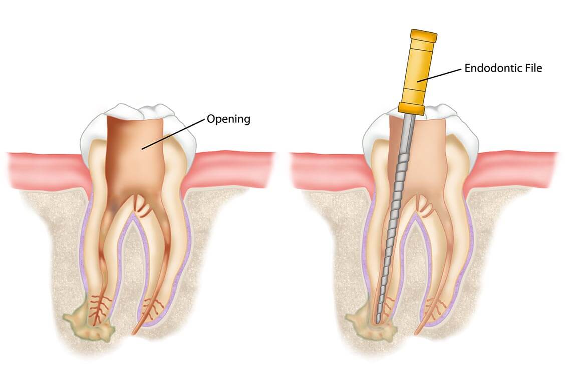 tratament-endodontic-arad